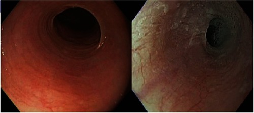 Figure 1 Endoscopic views of esophageal web thin membranes of esophageal mucosa found either anterior, posterior or circumferential.