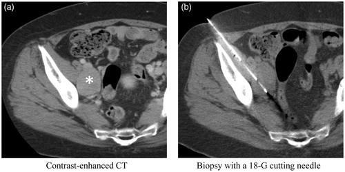 Figure 2. Representative case showing biopsy of a pelvic mass from a woman in her 60s. (a) Contrast-enhanced CT of the pelvis demonstrates an enhanced mass (asterisk) between the right external and internal iliac vessels. (b) Biopsy was performed using an 18-G cutting needle without penetration of the iliac arteries and veins.