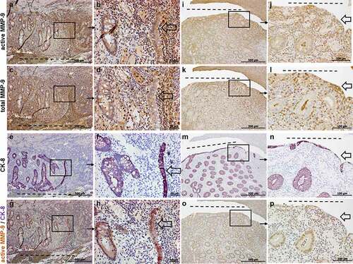 Figure 2. Representative images of immunohistochemistry staining results for active (a, b, i, j), total MMP-9 (c, d, k, l), CK-8 (e, f, m, n) and active MMP-9 and CK-8 co-staining (g, h, o, p) in CD entero-enteric fistulas (n = 6). Figures A-H show an entero-enteric fistula with abnormal crypts and myofibroblast-like single cells and TC (transitional cells: epithelial cells with mesenchymal cell phenotype) entering tissue. In Figures I-P, a different representative entero-enteric specimen, myofibroblast-like single cells and TC are found lining the fistula tract. Those cells as well as abnormal crypts are positively stained for active MMP-9 and CK-8. Total MMP-9 expression is found in some scattered myofibroblast-like cells and TC cells (c, d, k, l). From 2 specimen, A, C, E, G and I, K, M, O are consecutive sections and B, D, F, H and J, L, N, P are magnifications of the respective quadrants. Dashed line indicates the fistula tract. Small arrows indicate enlargements. Large arrows indicate TC.