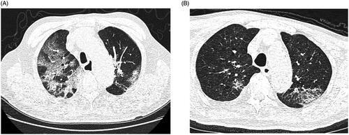 Figure 1. Representative chest CT findings in the death group (A) and survival group (B).