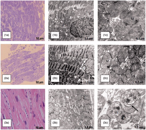 Figure 3. Light and electron microscopic findings of myocardial biopsies in patients with hypertrophic cardiomyopathy-causing mutations in genes encoding sarcomere proteins reflect the severity of macroscopic disease and arrhythmia vulnerability. Patients 1 and 2, a 17-year-old girl and her 19-year-old male first cousin, respectively, are carriers of the HCM-causing Finnish founder mutation in the α-tropomyosin gene (TPM1-D175N). Patient 1 had no signs or symptoms of HCM and was considered a healthy mutation-carrier. The LVMWT in CMRI was 10 mm. Patient 2 had a LVMWT of 24 mm in CMRI, severe symptoms, and several risk factors for SCD. Subsequently, an ICD was implanted. Patient 3, a 14-year-old boy, died of electric VT storm, irrespective of a functional ICD, after falling in the ski slope. On the last echocardiography, the LVMWT was 29 mm; LV dimensions were 54/37 mm and ejection fraction was 57%. The patient had a previous history of ventricular tachycardia and several aborted SCDs but no overt heart failure. In the postmortem genetic analysis, a rare disease-causing mutation in the β-myosin heavy chain gene was found (MYH7-R453C). Part labels 1a, 2a and 3a show growing hypertrophy of myocytes (light microscopy, bar 50 μm) in the endomyocardial biopsies (1a: normal muscle/mild hypertrophy, 2a: moderate hypertrophy) and the postmortem heart specimen (3a: marked hypertrophy) in patients 1, 2 and 3, respectively. Part labels 1b, 2b and 3b show increasing derangement of myocyte ultrastructure, including myofibril disarray, abnormalities of Z-lines (Z), and vacuoles (V) [electron microscopy (EM), bar 1.5 μm) in patients 1–3. Part label 3b displays partial loss of myofibril integrity in patient 3. In patients 1 and 2 (Part labels 1c and 2c), no unequivocal changes are evident in mitochondria (M) (EM, bar 0.3 μm). Part label 3c shows swollen mitochondria with anomalous cristae, internal rod-like structures (arrow) and large dark calcium deposits (asterisk) (EM, bar 0.3 μm) in the severely affected patient 3.