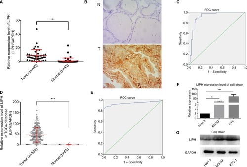 Figure 1 LIPH was relatively overexpressed in PTC tissues and PTC cell lines.Notes: (A) The expression levels of LIPH in 45 PTC tissues and their paired adjacent normal thyroid tissues were measured by qRT-PCR (Mann–Whitney U test, ***P<0.001). (B) Immunohistochemical analyses were performed to examine the expression levels of LIPH in PTC tissues and adjacent normal tissues (6/6 vs 0/6, ***P<0.001). Magnification ×400. (C) The ROC curve was constructed from the LIPH mRNA expression levels in diagnosing PTC in the validation cohort (AUC 92.0%, P<0.001; sensitivity 88.9; specificity 86.7%). (D) The expression levels of LIPH in 504 PTC tissues and 60 normal thyroid tissues were measured by qRT-PCR (Mann–Whitney U test, ***P<0.001). (E) The ROC curve was constructed from the LIPH mRNA expression levels in diagnosing PTC in the TCGA cohort (AUC 94.0%, P<0.001; sensitivity 87.4; specificity 96.6%). (F) The relative expression levels of LIPH in KTC-1 and BCPAP were significantly higher than in Htori-3 (two-tailed Student’s t-test, **P<0.01, ***P<0.001). (G) The corresponding protein expression levels of LIPH in KTC-1 and BCPAP.Abbreviations: AUC, area under the curve; GqRT-PCR, quantitative reverse transcription PCR; LIPH, lipase H; N, normal tissue; PTC, papillary thyroid carcinoma; T, tumor tissue; TCGA, The Cancer Genome Atlas; ROC, receiver operating characteristics..