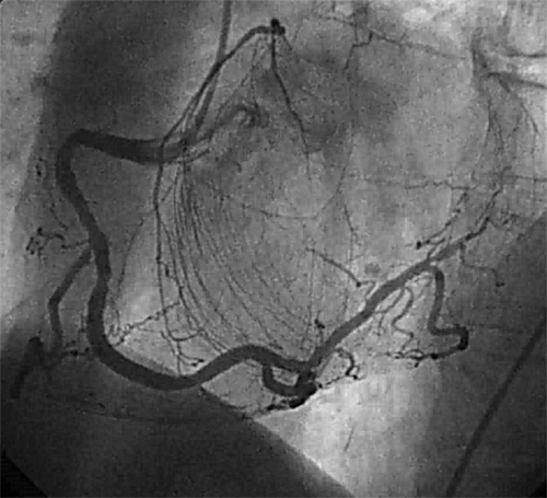 Figure 1.  Contrast injected into the right coronary artery in a patient with complete total occlusion of the left main coronary artery. The left ventricular epicardial arteries are filled via extensive collaterals.