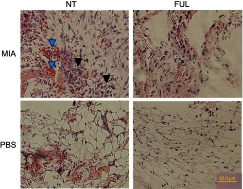 Figure 5 Representative H&E staining of synovium from rat knee joints (control: PBS, injured: MIA) with (FUL) or without (NT) fullerol treatment for 5 days.Notes: Fullerol of 2 mg/kg weight was administered intravenously immediately after MIA injection. The results showed that fullerol reduces red blood cells (blue arrows) and fibroblast-like cells (black arrows) in the synovium of the injured knee seen in the up/left image of the MIA/NT group.Abbreviations: FUL, fullerol; MIA, monoiodoacetate; NT, no treatment.