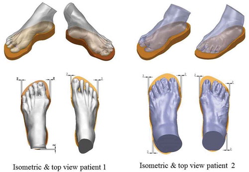 Figure 4. Top view and new isometric 3D design of the foot assembly a insole for two diabetic patients.