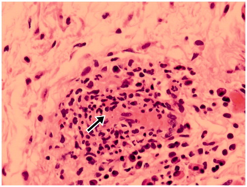 FIGURE 2. Conjunctival biopsy specimen showing vasculitis (arrow) in microscopic polyangiitis.