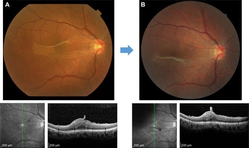Figure 1 Auto-peeling of idiopathic ERM can be seen in these fundus photos and macular OCT from a 33-year-old female with idiopathic ERM. These photos and OCT were taken in (A) July 2010 and (B) October 2012. Visual acuity was improved from 10/20 to 14/20.