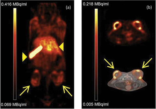 Figure 5. MicroPET/CT-images of a mouse bearing human colon adenocacinoma (HT29, arrows) on their right and left flank. Image acquisition was performed 24 h post injection of 64Cu-labelled PEGylated liposomes (a) Coronal PET image showing both tumours (arrows). The characteristic uptake of liposomes in spleen and liver is also visualized (arrowheads). (b) Axial PET image (top) and PET/CT image (bottom), showing both tumours (arrows) (Reproduced with permission from Petersen et al. [Citation56]).