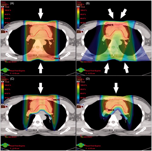 Figure 1. Three-dimensional conformal radiotherapy (A), intensity-modulated radiotherapy (B), proton double scattering (C), and pencil beam scanning (D) treatment plans for a patient. The contour shown is the internal target volume.