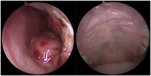 Figure 1. A nasal endoscopy shows a bulge from the left floor of the nose to the bottom of the nasal septum, but there is no bulge in the palate.