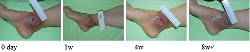 Figure 6. Zhao Xiujuan, female, 59 years old, suffered from skin ulceration of the right ankle with infection. The infection was recurrent and uncured for more than 1.5 months. The wound healing rate was 89% after 8 weeks of routine dressing change treatment.