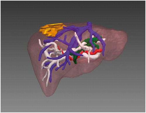 Figure 2. The 3D reconstructed image including the tumor (yellow), portal vein (white), hepatic vein (blue), artery (red) and gall bladder (green).