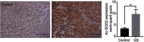 Figure S1 Representative images of liver sections from patients for immunostaining analysis using an Ac-SOD2 antibody. Scale bar, 100 μm. **p<0.01.