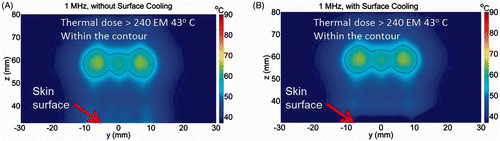 Figure 6. Simulated temperature distribution and thermal dose contours (inner contour > 240EM 43 C) for the 1.0 MHz transducer, (A) without cooling and (B) with skin pre-cooling, after 30 seconds of sonication, with transducer emittance of 3 W/cm2. The skin surface is at z = 30 mm. The skin temperature prior to ablation was 8°C.
