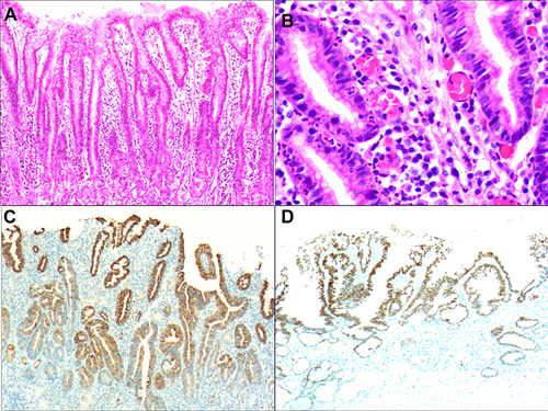 Figure 4 Excessive upward migration of the stem cells in the proliferative region. (A) Massive propagation of cells in the proliferating region resulted in the formation of a histologically characteristic papilloma-like structure; H&E staining, ×100. (B) Enlarged nuclei, one-to-two times the size of the nuclei in the normal surface epithelial cells, with mild to moderate heterotypy; H&E staining, ×400. (C) Positive for MUC5AC, EnVision method, ×200. (D) Positive for CDX2, EnVision method, ×100.