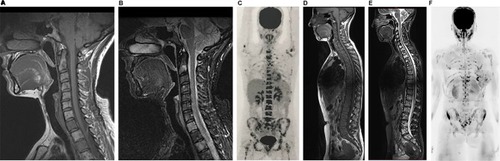 Figure 7 A 56-year-old female patient with a diagnosis of ER-positive, PR-positive, and HER2-negative invasive ductal carcinoma, undergoing treatment with anthracycline, cyclophosphamide, and tamoxifen.Notes: On the first evaluation in March 2017, cervical spine MR with sagittal T1 and STIR sequences (A and B) show several bone lesions suggestive of metastases along this spine segment. A PET/CT performed in April 2017 showed numerous lesions in axial and proximal appendicular skeletons (C). Based on the PET/CT result, treatment with an aromatase inhibitor, bisphosphonate (zoledronic acid), and target therapy with denosumab was initiated. In June 2017, the patient underwent whole-body MR (D–F). A follow-up analysis based on sagittal T1 sequences alone (A and D) yielded a false interpretation of disease progression due to a lower signal in the bone marrow (E). However, an evaluation of (E) along with the diffusion-weighted sequence (b800) with reformatted MIP in inverted grayscale (F) shows that the latter has no signs of viable tumor tissue in the cervical spine; also, in comparison with the PET/CT images, the number of bone lesions is substantially lower, suggesting a partial response. In other words, a pattern of pseudoprogression is suggested if the T1-weighted sequences are considered alone.Abbreviations: CT, computed tomography; FDG, fluorodeoxyglucose; MIP, maximum intensity projection; MR, magnetic resonance; PET, positron emission tomography; STIR, short-tau inversion-recovery.