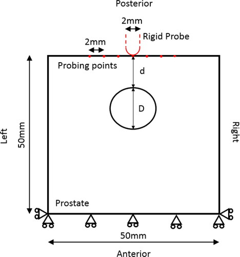 Figure 2. Schematic of simplified 2D prostate model with a single PCa nodule embedded in it.