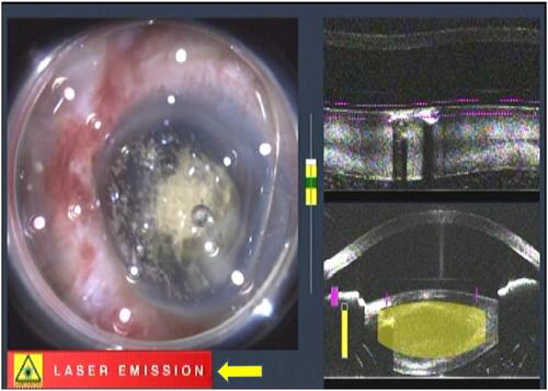 Figure 5 Misplacement of the laser beam in the corneal layers immediately after the suction break. The device is still emitting the laser beam (yellow arrow).