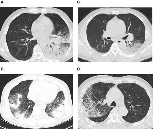 Figure 1 (A) Chest computed tomography (CT) of Case 1: consolidation in left lower lung and a small amount of pleural effusion on the left. (B) Chest CT of Case 2: large exudative consolidation foci in both lungs, mainly in the lower lobe, and a small amount of pleural effusion on both sides. (C) Chest CT of Case 3: consolidation in both lower lungs, mainly on the left and bilateral pleural effusion. (D) Chest CT of Case 4: right lung consolidation and ground-glass shadow.