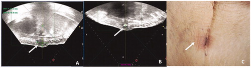 Figure 2. Ultrasound and skin imaging in a 35-year old woman with endometriosis of the abdominal muscle layer. (A) Before HIFU, sagittal guided ultrasound showed a low echogenic nodule of approximately 33 mm in the right subcutaneous muscle layer of the abdominal wall incision. Distances from the superficial and deep areas of the lesion to skin surface were 6 mm and 29 mm, respectively. (B) The bladder was filled with 400 ml normal saline to push the intestine behind the lesion. During the operation, ultrasound energy of fixed-point emission was 12000 J, and the focus position showed a massive hyperechoic change. There was no significant echo change in the superficial tissue of the lesion. (C) After HIFU, skin surface was slightly swollen and the skin was intact.