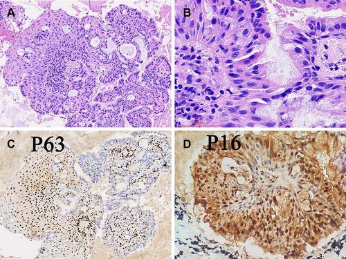 Figure 3 (A) Tumor B consisted of branching papillary structures with an axis of fibroblasts, showing a mixture of squamous and glandular cells; (B) Pseudostratified ciliated columnar tumor cells; (C) Immunostaining showing that some tumor cells are positive for the expression of p63; (D) Both components were focally positive for P16.