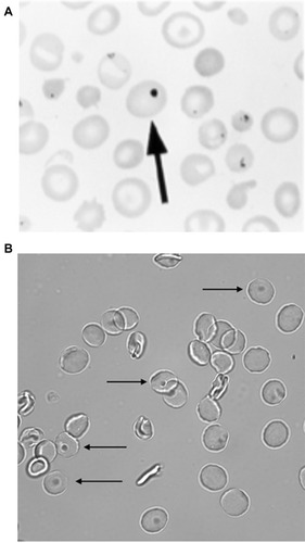 Figure 2 Erythrocyte tests of splenic function: (A) Howell–Jolly bodies (Reprinted with permission from Detection, Education and Management of the Asplenic or Hyposplenic Patient, February 1, 2001, Vol 63, No 3, American Family Physician Copyright © 2001 American Academy of Family Physicians. All Rights ReservedCitation32) (B) Pitted erythrocytes.Notes: The arrow in Panel A shows the Howell-Jolly Body in the erythrocyte. The arrows in Panel B indicates the pitted erythrocytes.