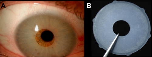 Figure 1 A) Anterior chamber image. The NewIris lens is positioned over the whole surface of the iris. Corneal incision to insert the lens is at twelve o’clock with a size of 2.8 mm; B) Iris lens diaphragm after explantation.