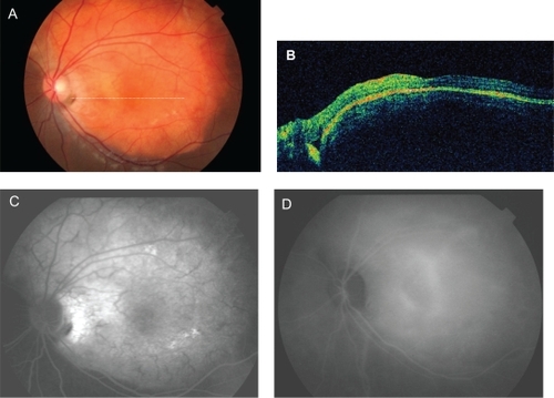 Figure 3 Patient with a choroidal osteoma and choroidal neovascularization 18 months after two intravitreal injections of bevacizumab. Fundus photograph (A), horizontal optical coherence tomographic scan (B), fluorescein angiography indocyanine angiography (C), and indocyanine angiography (D) all show absence of subretinal fluid and leakage points.