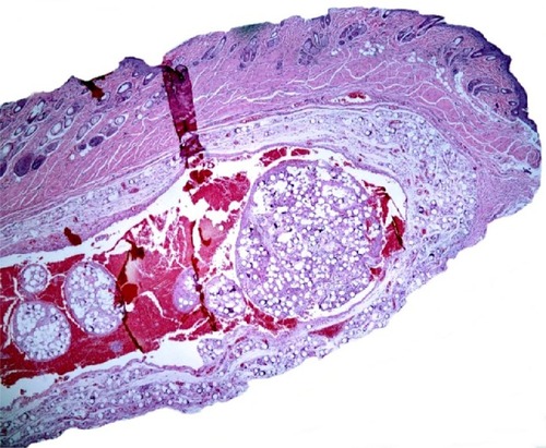 Figure 4 Microscopic appearance of PMMA injection in submucosal group 3 months after PMMA injection, (hematoxylin-eosin, in minor magnification).