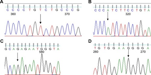 Figure 4 DNA sequencing result of the ARSA gene. (A) Sequence with a new G>T homo W195C mutation (patient 12). (B) Sequence with a new T>A homo F221I mutation (patient 2). (C) Sequence with a new C>G homo D283E mutation (patient 8). (D) Sequence with a new A>G homo K304R mutation (patient 6).