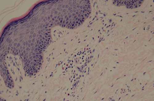 Figure 3 Lymphocytic and eosinophilic infiltration around blood vessels in the dermis (HE, x200).