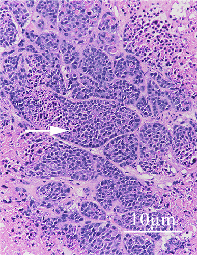 Figure 7 Image of HE-stained tissue area excised after identification of the subcutaneous small-cell lung cancer tumor in the nude mouse model with the probe (10 μm, the white arrow points to the cancer cells).