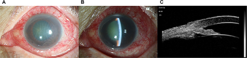 Figure 3 A 67-year-old woman with APAC attack after COVID-19 inflection. (A and B): Slit lamp images showed apparent conjunctival hyperemia, corneal epithelial and stromal edema, enlarged pupil, and shallow anterior chamber in left eye. (C): Ultrasound biomicroscopy image showed iris trabecular contact, closed angle, and shallow anterior chamber.