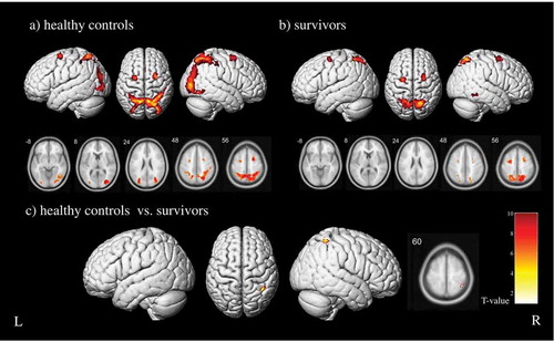 Figure 3. Working memory network in healthy controls and survivors. First-level contrast comparing working memory task blocks vs control task blocks in (a) healthy controls and (b) survivors of childhood cancer without CNS involvement (p < .05, FWE corrected, k > 40). (c) Factorial design contrasting controls and survivors (controls > survivors, p < .001, uncorrected, k > 30). Main activation clusters are presented in render view. L = left, R = right. The reverse contrasts (control task blocks > working memory task blocks, survivors > controls) did not yield any significant suprathreshold clusters
