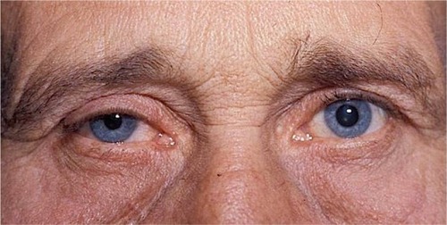Figure 1 Right Horner syndrome in a 65-year-old man. Note right-sided upper lid ptosis, right miosis, and “upside-down” ptosis (ie, elevation) of right lower lid.