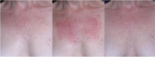 Figure 1 Transient welts following Ultherapy® as a result of application of excess gel and their resolution 3 weeks later (Courtesy of Dr Sabrina Fabi).