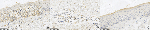 Figure 6 Expressions of IRF7 in chronic eczema lesions and the perilesional normal skin at the edge (SP *400). (a) Epidermic of skin lesion. (b) Dermis of skin lesion (c) Perilesional normal skin. (a) More IRF7+ cells with brown cytoplasm were observed in the epidermal of chronic eczema lesions. (b) More IRF7+ cells with brown cytoplasm were observed in the dermal papillary layer of chronic eczema lesion. (c) Almost no of IRF7+ cells with brown cytoplasm were observed in both epidermal and papillary layer of perilesional normal skin of the lesion.