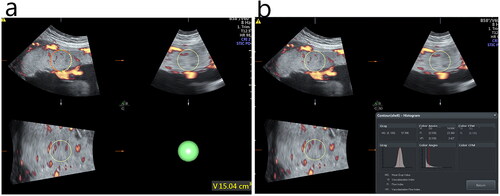 Figure 2. Measurement of 3D-PDU blood flow parameters vascularity index (VI), flow index (FI) and vascularity flow index (VFI) at the umbilical cord insertion point of the foetal placenta in the isolated single umbilical artery (ISUA) group and control group.