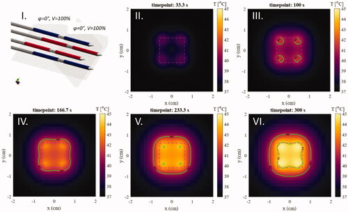 Figure 6. Temperature distribution maps on plane A (see Figure 3 for geometry) for five consecutive timepoints in the first five minutes of heating in the static phase configuration: (I). The static phase configuration was applied. Blue: 0 phase shift, Red: 180° phase shift; (II) t = 33.3s; (III) t = 100 s; (IV) t = 166.7s; (V) t = 233.3s; (VI) t = 300s. The VOI is visible as a dashed purple line, as are the isotemperature contours (green lines) of 41 and 44 °C.