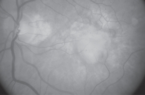 Figure 2 Disciform scar following PDT. Fundus picture of a patient with AMD-related SFCNV that evolved into a disciform scar following two sessions of PDT. This was the largest scar that developed following treatment (GLD: 4700 μm).