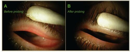Figure 8 Case study of probing for a 66-year-old woman with obstructive MGD (upper lid): (A) before probing, the left upper lid had 0 expressible glands and VAS showed 44 out of 100 scale for tenderness for a diagnosis of complete distal obstruction (CDO), while 1 week after probing (LU After); (B) the same lid had more than 10 expressible glands and VAS showed 7 of 100 in tenderness for a diagnosis of partial distal obstruction (PDO). Reproduced with permission from Maskin SL. Intraductal meibomian gland probing: a paradigm shift for the successful treatment of obstructive meibomian gland dysfunction. In: Tsubota K, ed. Diagnosis and treatment of meibomian gland dysfunction. Tokyo, Japan: Kanehara & Co., Ltd; 2016:149–167.Citation7
