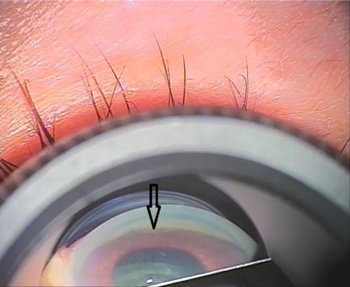 Figure 9 Gonioscopy showing the tube in the anterior chamber.