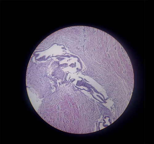 Figure 2 Histopathology of umbilical nodule showing benign endometrial tissue with skin overlying it.