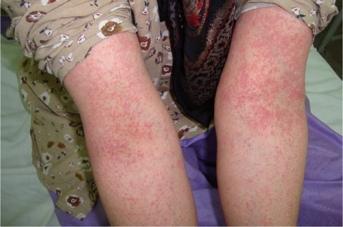 Figure 1 A 25-year-old woman with the diagnosis of acute generalized exanthematous pustulosis following the use of cephalexin.