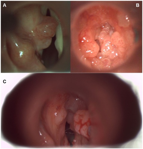 Figure 1 (A-C). Direct laryngoscopy view of laryngeal papillomas.