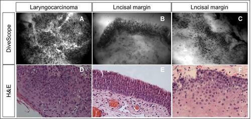 Figure 6 DiveScope images and hematoxylin-eosin staining pathology images of head and neck squamous cell carcinoma and resection margin tissues. Figures (A and D) show a DiveScope image and an HE staining pathology image of laryngeal cancer tissues. Figures (B, C, E, and F) show DiveScope images and HE staining pathology images of laryngeal cancer resection margin tissues. Figures (A and D) show the large nuclei, deep staining, and irregular morphology of laryngeal cancer cells. Figures (B and E) show the regular morphology and neat arrangement of squamous epithelial cells in laryngeal cancer resection margin tissues and no heterotopic nuclei. Figures (C and F) show normal squamous epithelial cells and scattered inflammatory cells.