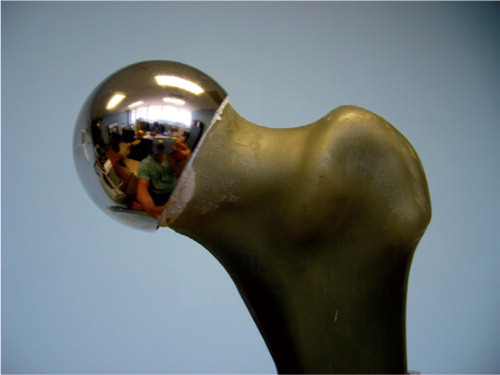Figure 1. A synthetic composite model femur with a femoral resurfacing component implanted to optimize fixation and minimize bone loss.
