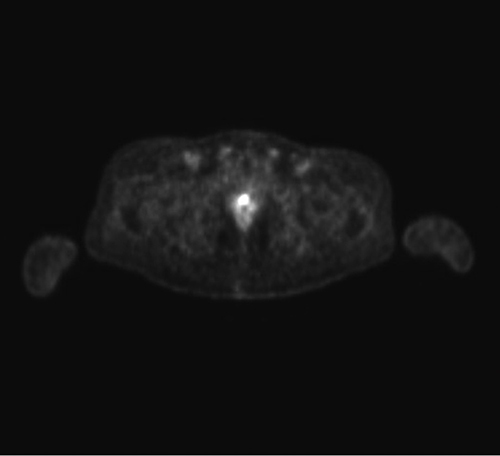 Figure 2 PSMA PET image of the prostate lesion.