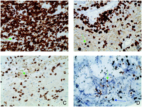 Figure 5. CD3 quantities in the SLIM as function of abraded particle types and material combinations (indirect immunohistochemistry, original magnification about 200x) 5A: CD3 quantity with metal–metal pairing; 5B: CD3 quantity with metal–polyethylene pairing; 5C: CD3 quantity with ceramic–polyethylene pairing; 5D: quantity with ceramic–ceramic pairing. The green arrows indicate individual CD3+ lymphocytes. The blue arrow shows macroparticular ceramic material.