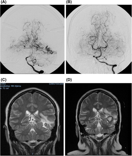 Figure 3. This shows radiology from the patient that developed a cavernous haemangioma 2 years after total occlusion of the AVM. (A) shows the AVM before and (B) after radiosurgery. (C) is the MRI when the patient started to have headaches, 2 years after B. (D) is the MRI just before surgery, showing a lesion in left temporal lobe surrounded by a prominent edema.